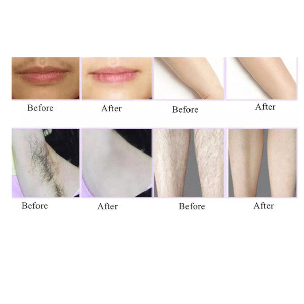 5 Level Laser Ipl Removal Machine Face Body Hair Shaving Epilator Kit